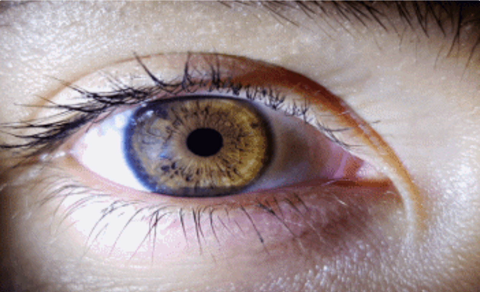 روش های پیشگیری از آب سیاه چشم چیست؟