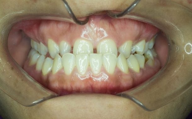 مشکل آندربایت چگونه توسط ارتودنسی درمان میشود؟