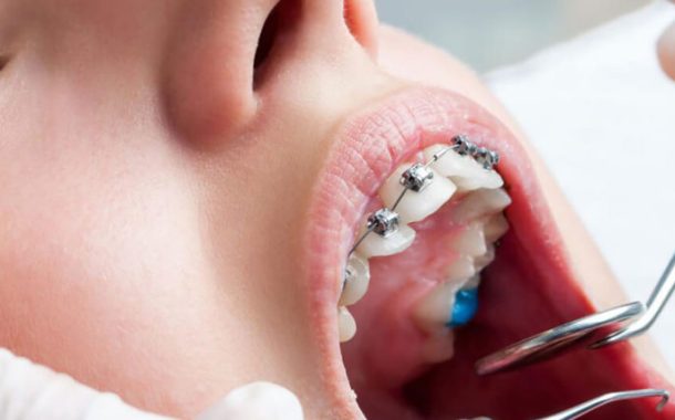 ایمپلنت دندان و ارتودنسی دندان کدام را ابتدا انجام دهیم؟