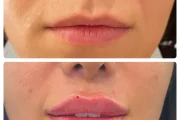 تزریق ژل لب در مشهد: از مدل روسی تا نچرال | کدام مناسب شماست؟