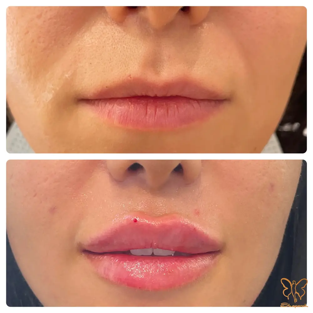 تزریق ژل لب در مشهد: از مدل روسی تا نچرال | کدام مناسب شماست؟