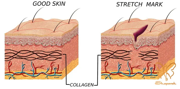 درمان ترک های پوستی با لیزر در مشهد | لیزر فوتونا برای بهبود قطعی استریا
