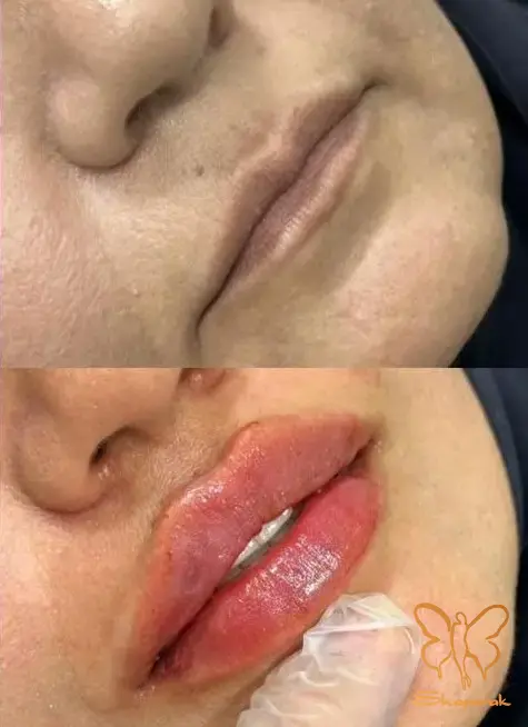 نمونه کار تزریق ژل لب کلینیک شاپرک مشهد