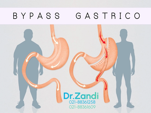 بررسی روش درمان چاقی با استفاده از عمل جراحی بای پس معده