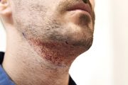 کاشت مو از طریق برداشت از ریش