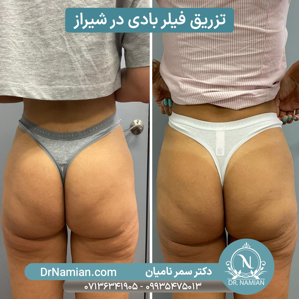 تزریق فیلر بادی در شیراز با دکتر سمر نامیان