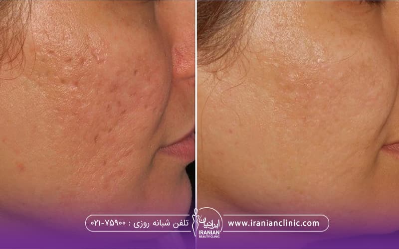 قبل و بعد صورت دختری که با لیزر اندولیفت جای جوش خود را از بین برده است
