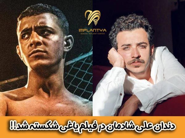 افزایش قیمت عمل بینی در سال 1401