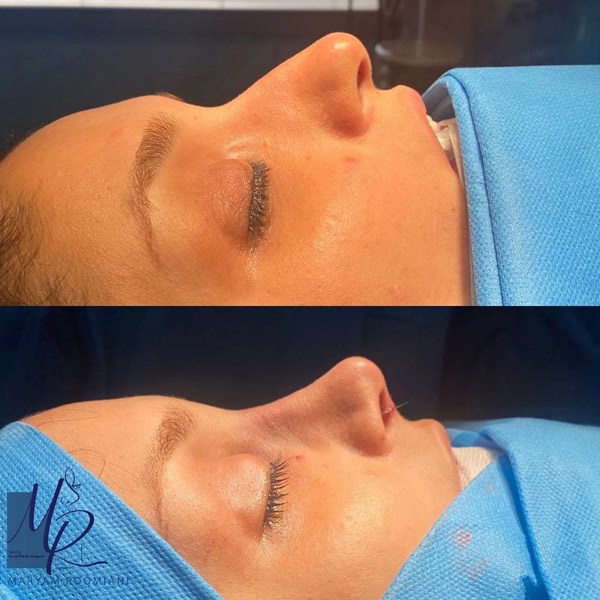 عمل رباط صلیبی زانو و نکات مهمی که باید بدانید