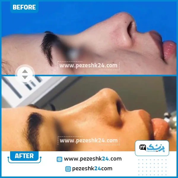 چه مدت بعد از تزریق کورتون ورم بینی میخوابد؟