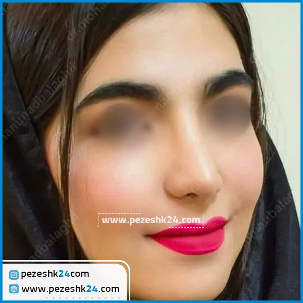 فرورفتگی بینی بعد از تزریق کورتون