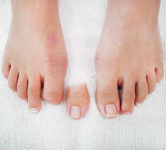 پروتز انگشت پا