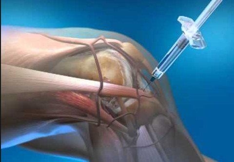 سلول درمانی زانو: راهنمای کامل به درمان با سلول‌های بنیادی