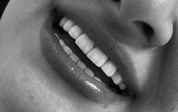 چگونه ایمپلنت دندانمان را ارزان تمام کنیم؟