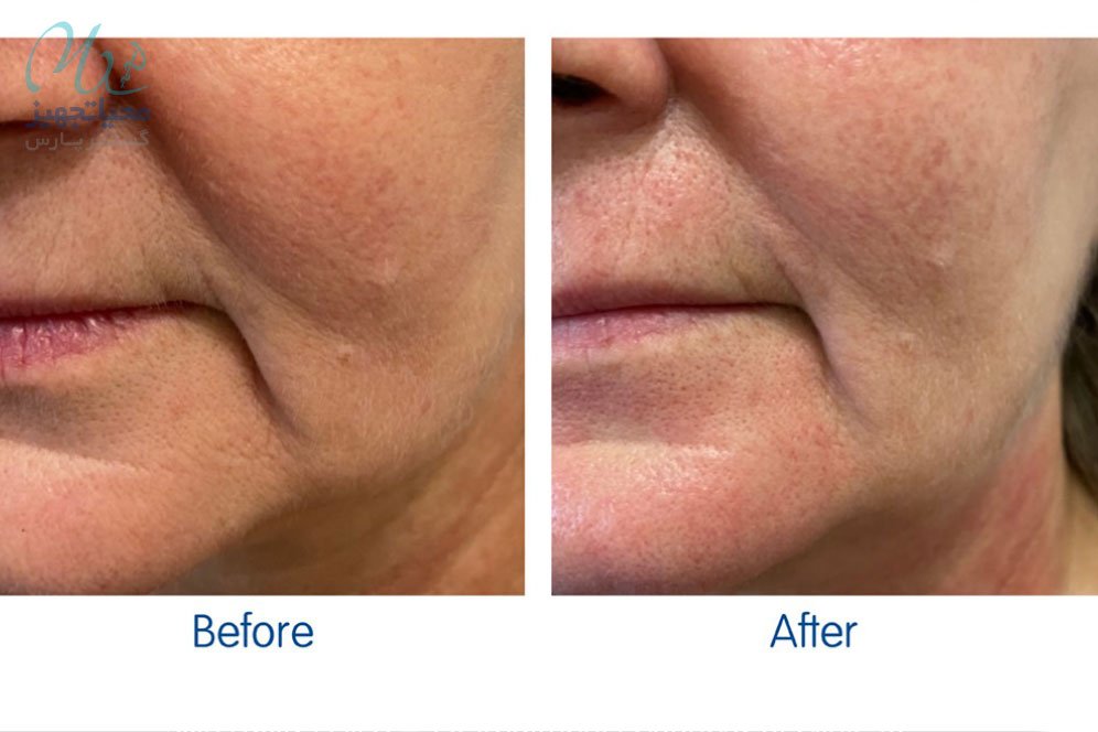 مزایای-هایفوتراپی-چیست؟