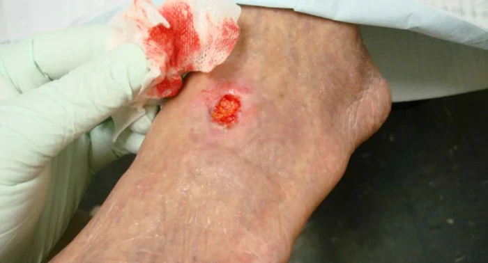 روش های قطعی درمان زخم عروقی: راهنمای جامع پیشگیری