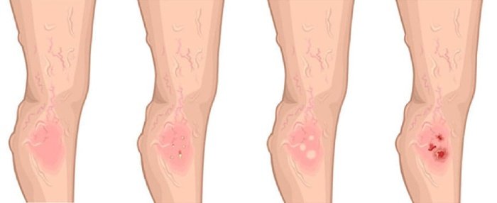 انواع زخم‌ های عروقی