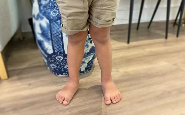 درمان پای ضربدری با ورزش: روشی موثر اما طولانی مدت